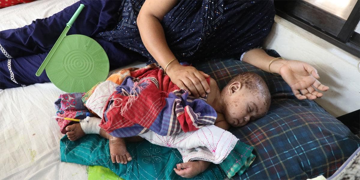 ২৫ বছরের রেকর্ড ভাঙলো হাম, বাড়ছে শঙ্কা