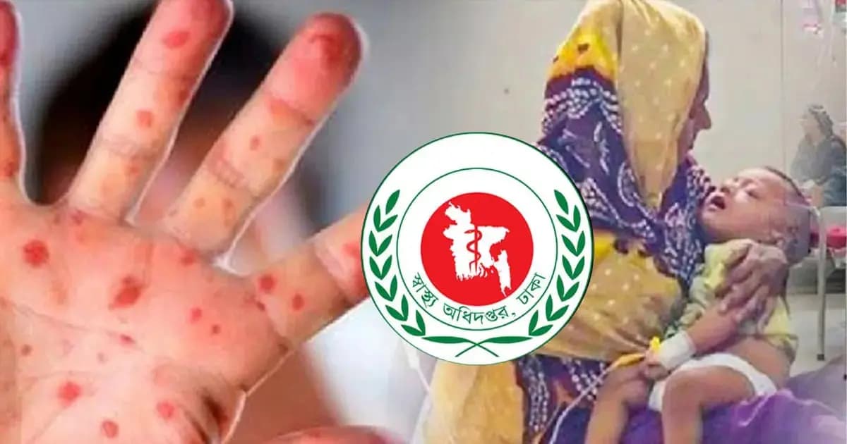 হাম ও উপসর্গে আরও ৬ জনের মৃত্যু