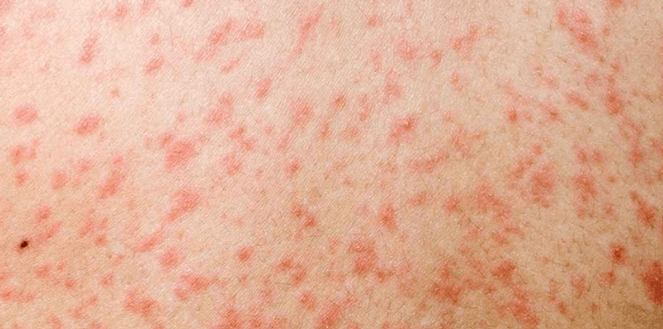 হামসহ সংক্রামক ব্যাধি থেকে বাঁচার দোয়া ও করণীয়