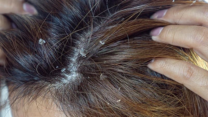 খুশকি থেকে মুক্তি পেতে করণীয়