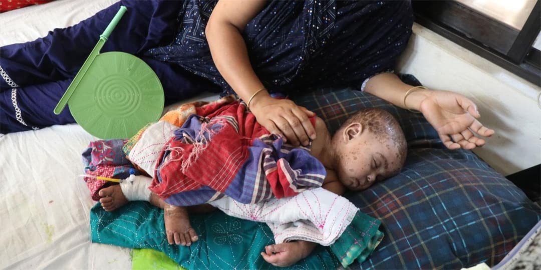 ২৫ বছরের রেকর্ড ভাঙলো হাম, বাড়ছে শঙ্কা